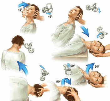 The "Printable:-Zcyatlgu_0= Epley Maneuver Pdf" emerges as an essential tool for both patients and healthcare professionals