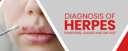 Can Herpes Cause High Blood Pressure